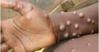 Monkeypox virus outbreaks are containable - WHO 