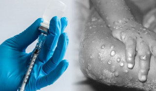 U.S. declares monkeypox outbreak a public health emergency